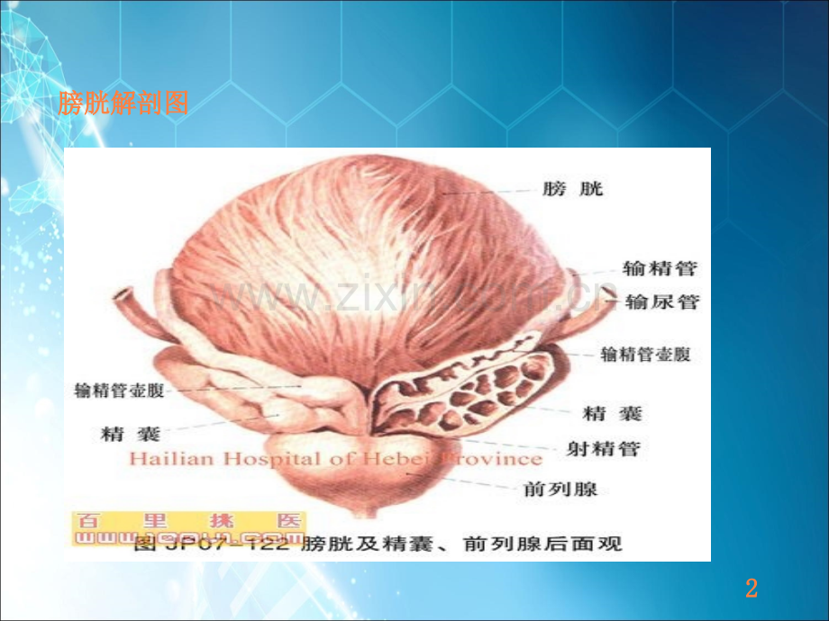 膀胱肿瘤电切术后并发症及护理ppt课件.ppt_第2页