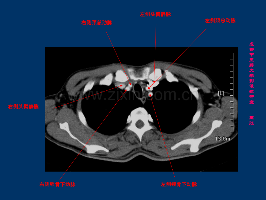 肺部CT-肺部纵隔窗ppt课件.ppt_第1页