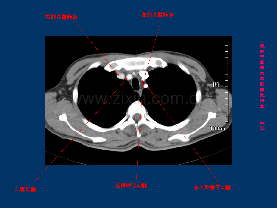 肺部CT-肺部纵隔窗ppt课件.ppt_第2页