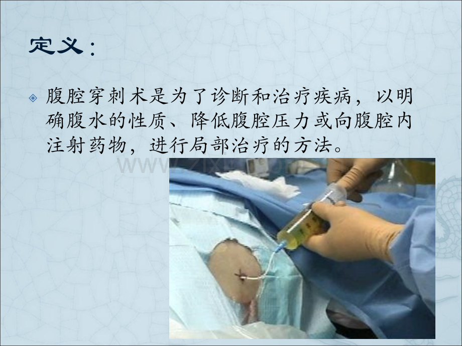 腹腔穿刺术及护理ppt课件.ppt_第2页