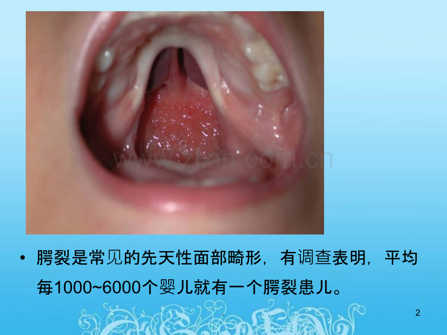 腭裂终极版ppt课件.pptx_第2页