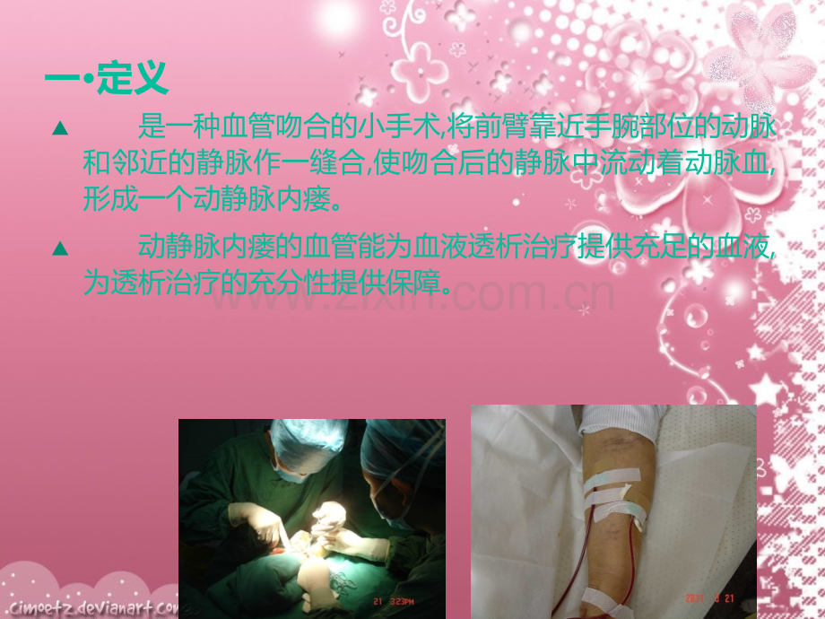 动静脉内瘘术的护理.ppt_第2页