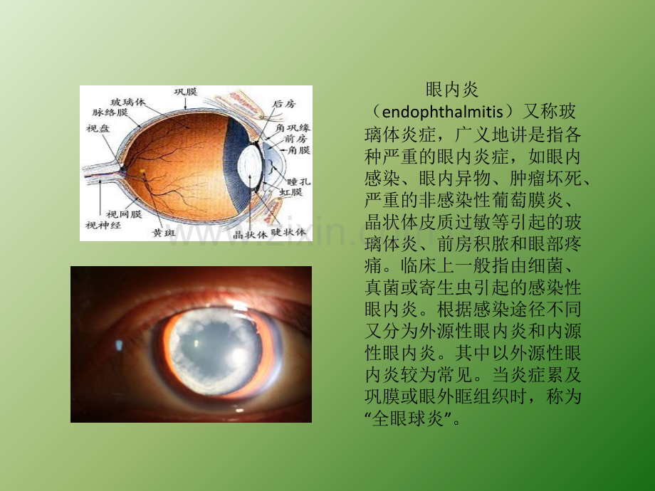 眼内炎患者的疾病.ppt_第2页