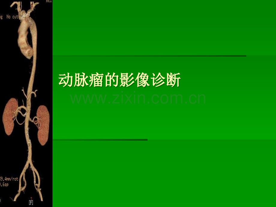 动脉瘤的影像诊断..ppt_第1页