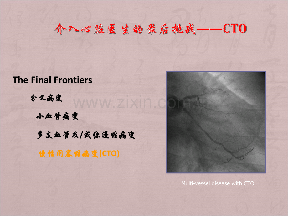 CTO病变介入治疗技巧.ppt_第2页