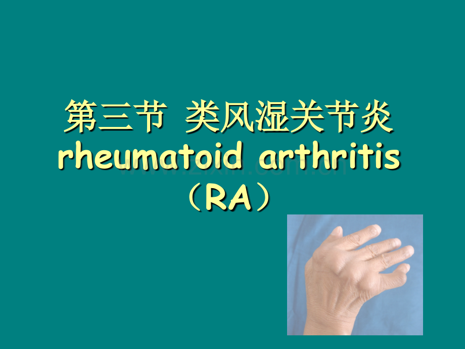8类风湿关节炎详解ppt课件.ppt_第1页