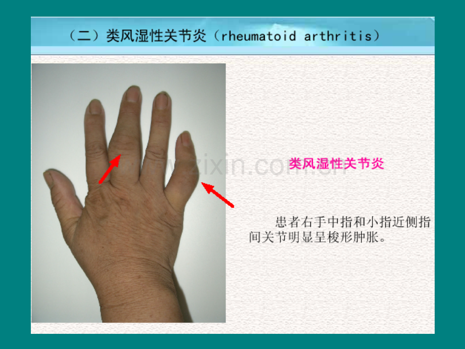 8类风湿关节炎详解ppt课件.ppt_第2页
