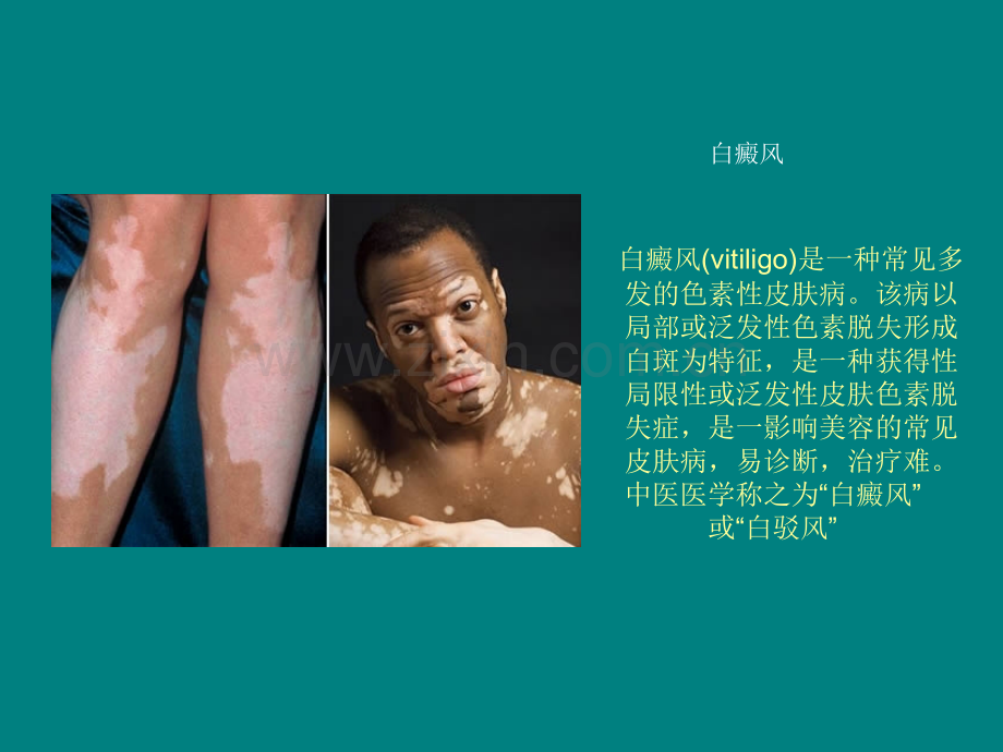 白癜风课件ppt课件.ppt_第2页