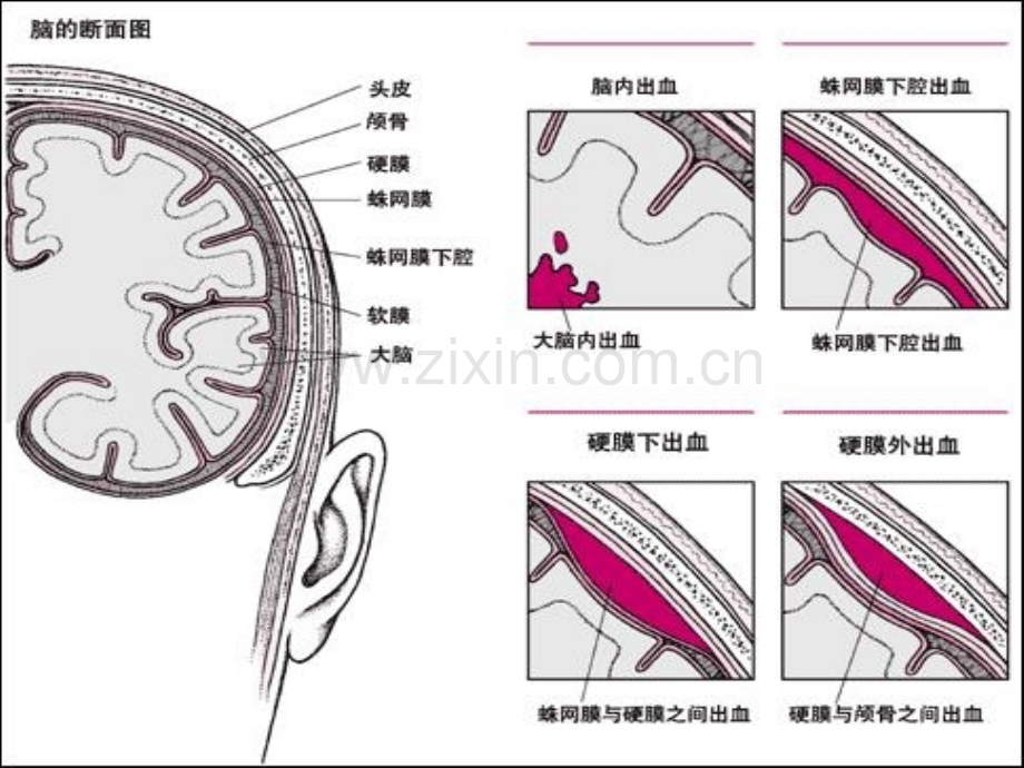 神经外科管道风险评估及护理进展.pptx_第2页