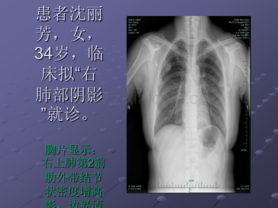 软骨源性肿瘤ppt课件.pptx_第2页