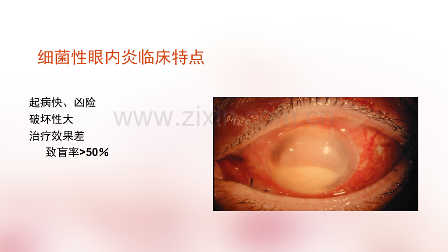 白内障术中预防细菌性眼内炎的意识和策略ppt课件.ppt_第2页