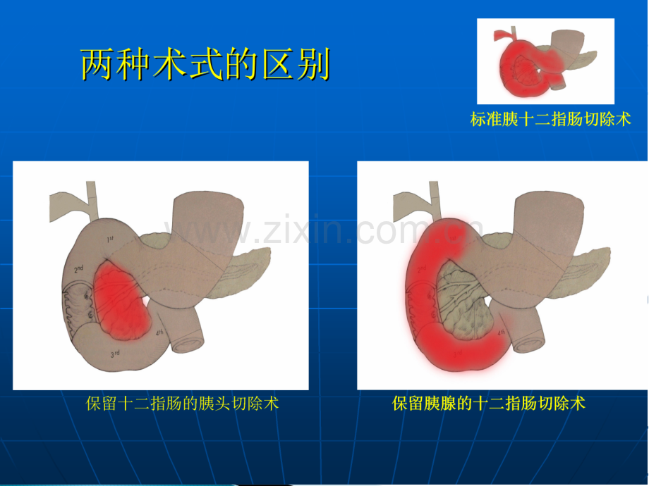 保留胰腺的胰十二指肠切除术ppt课件.ppt_第2页