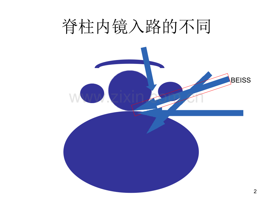 椎间孔镜Beis技术.pptx_第2页