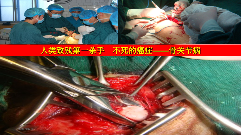骨关节病讲座.ppt_第2页