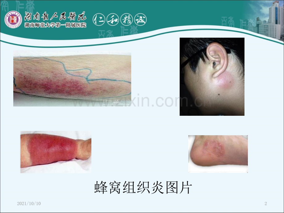 蜂窝组织炎.ppt_第2页