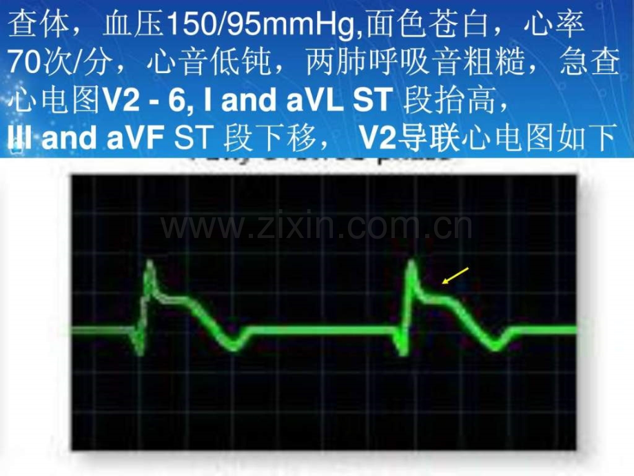 心血管病例讨论2011级5班3组.pptx_第2页