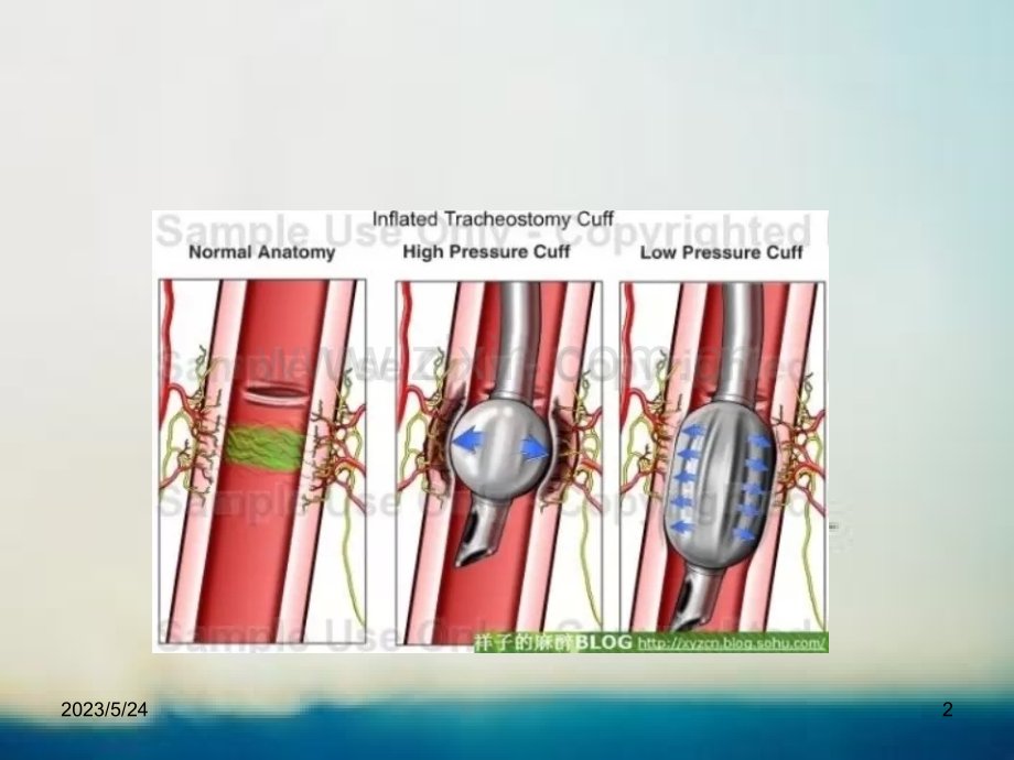 气管插管气囊充气.ppt_第2页