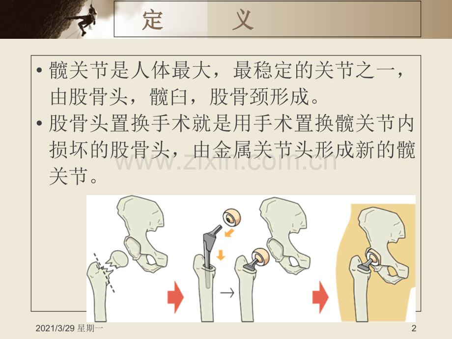 股骨头置换手术的护理查房.ppt_第2页