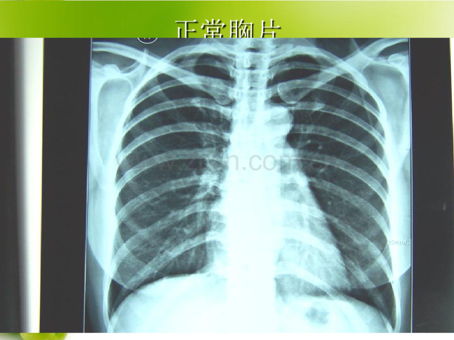 肺部常见病X线诊断.pdf_第3页