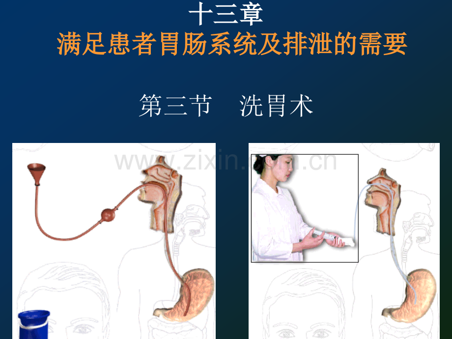 洗胃.ppt_第1页