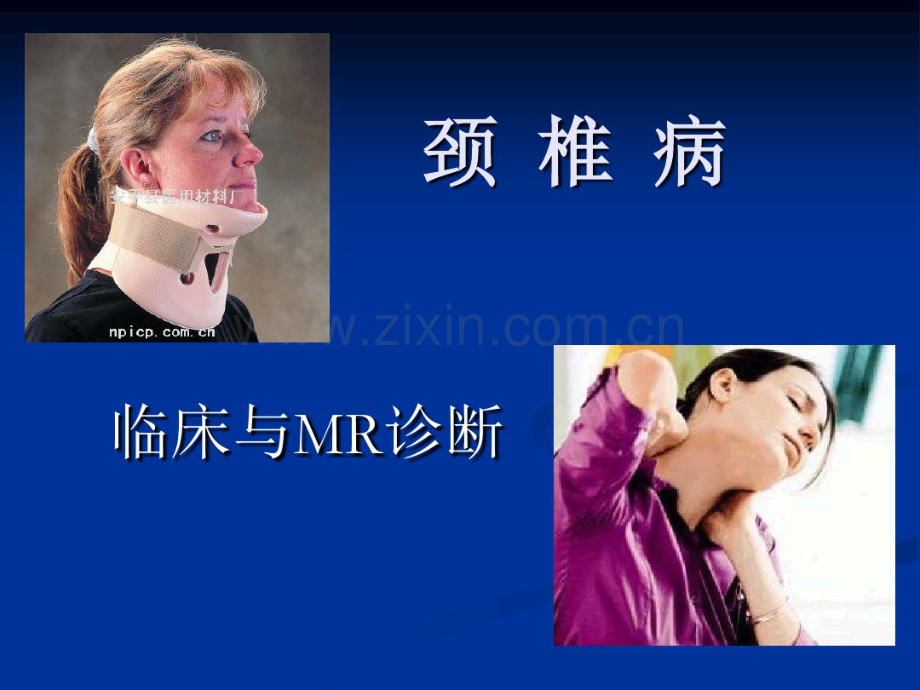 颈椎病的MRI诊断-(2).pdf_第1页