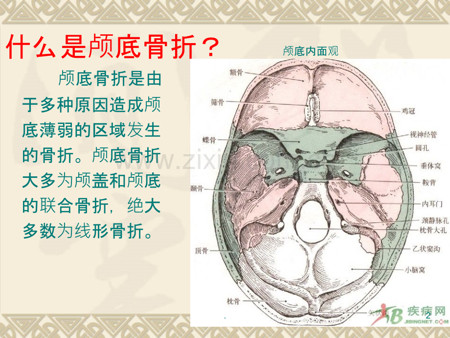 颅底骨折.ppt_第2页
