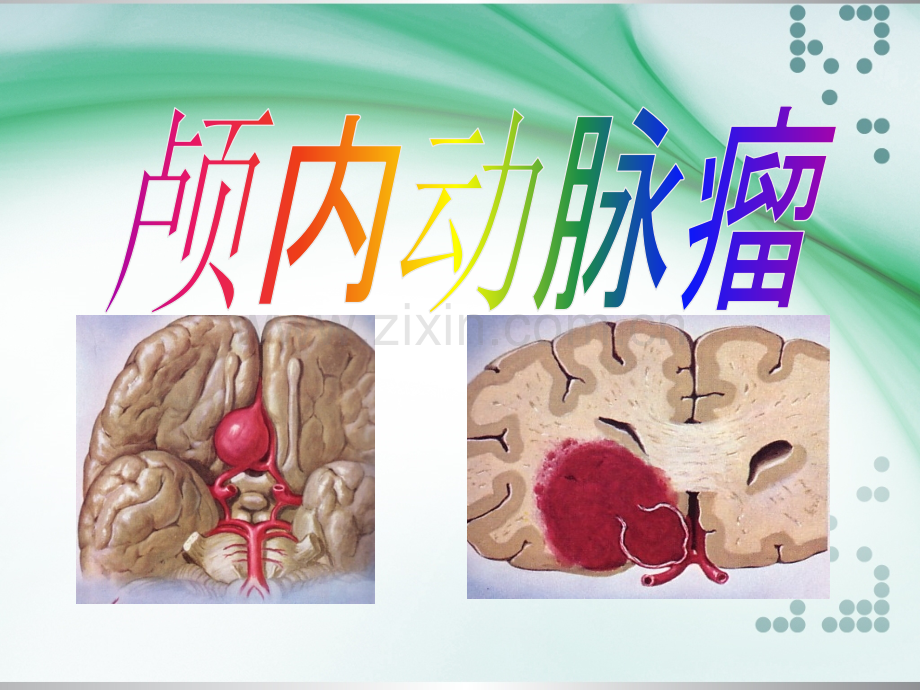 颅内动脉瘤介入术后的护理ppt课件.ppt_第1页
