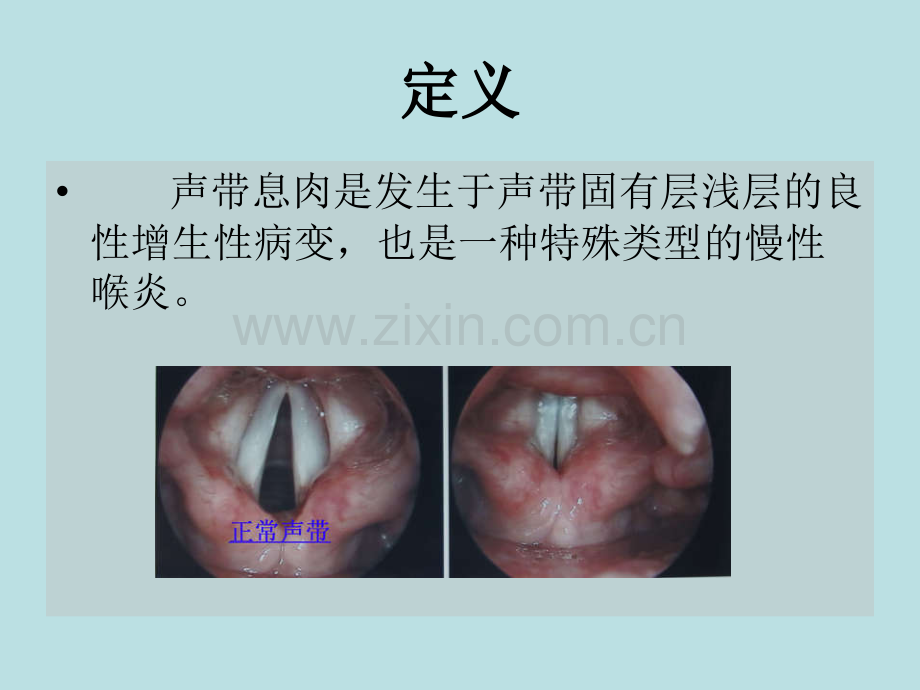 声带息肉1.pptx_第2页