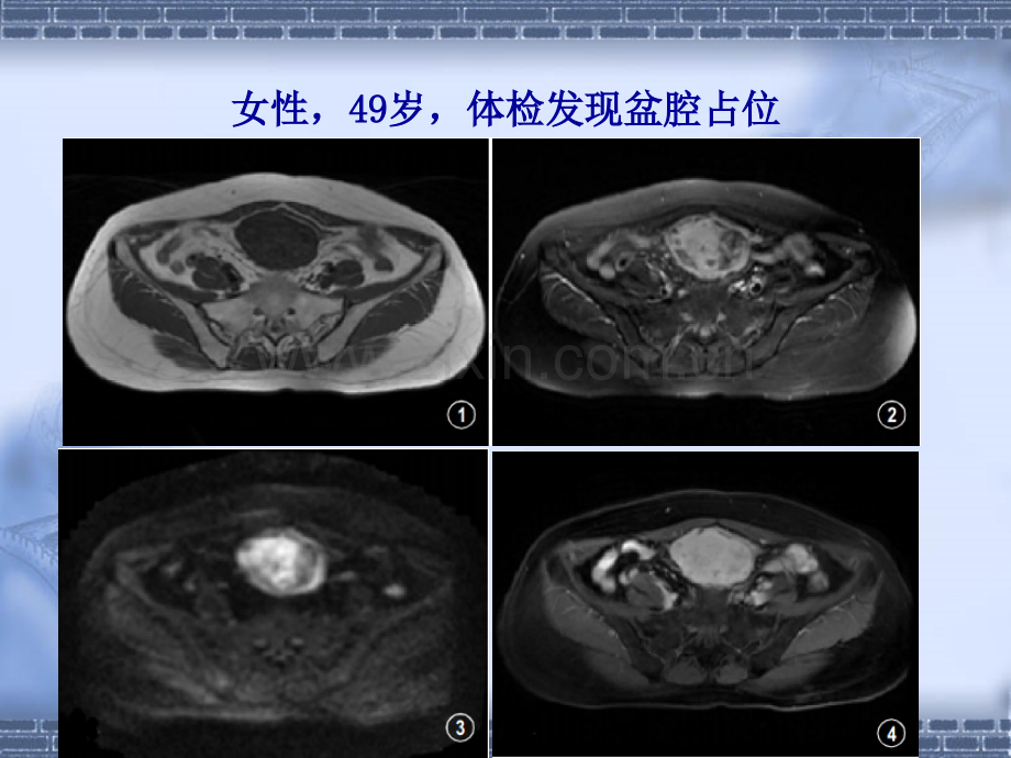 侵袭性纤维瘤病.ppt_第1页