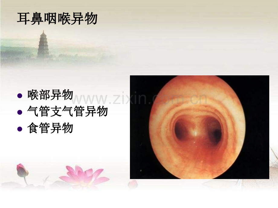 耳鼻咽喉、食道及气管异物-PPT.ppt_第2页