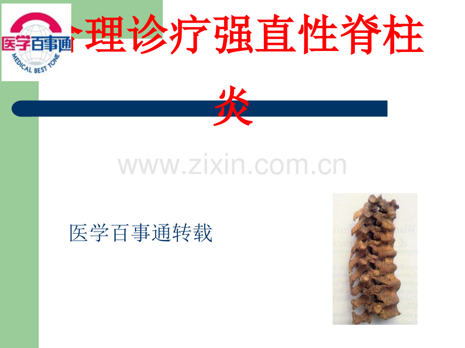合理诊疗强直性脊柱炎ppt课件.ppt_第1页