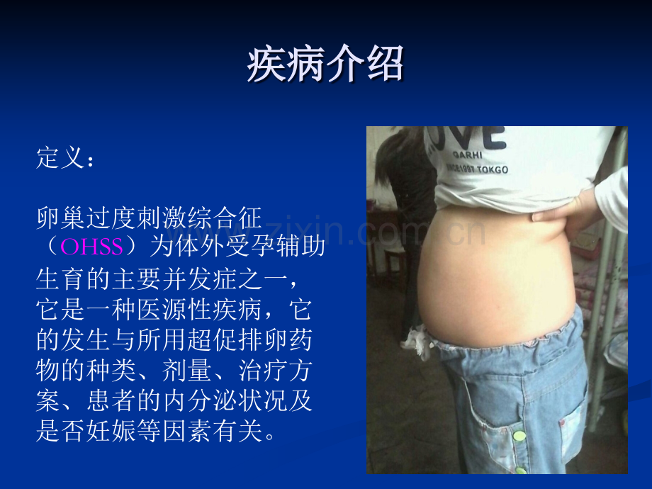 卵巢过度刺激综合征(OHSS)护理查房.ppt_第2页