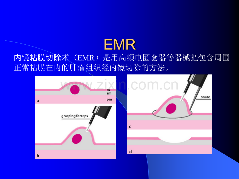 内镜下EMRppt课件.ppt_第1页