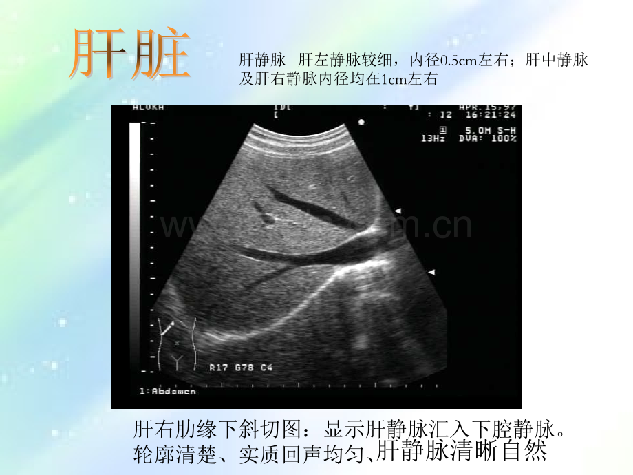 常见病B超图谱.ppt_第2页