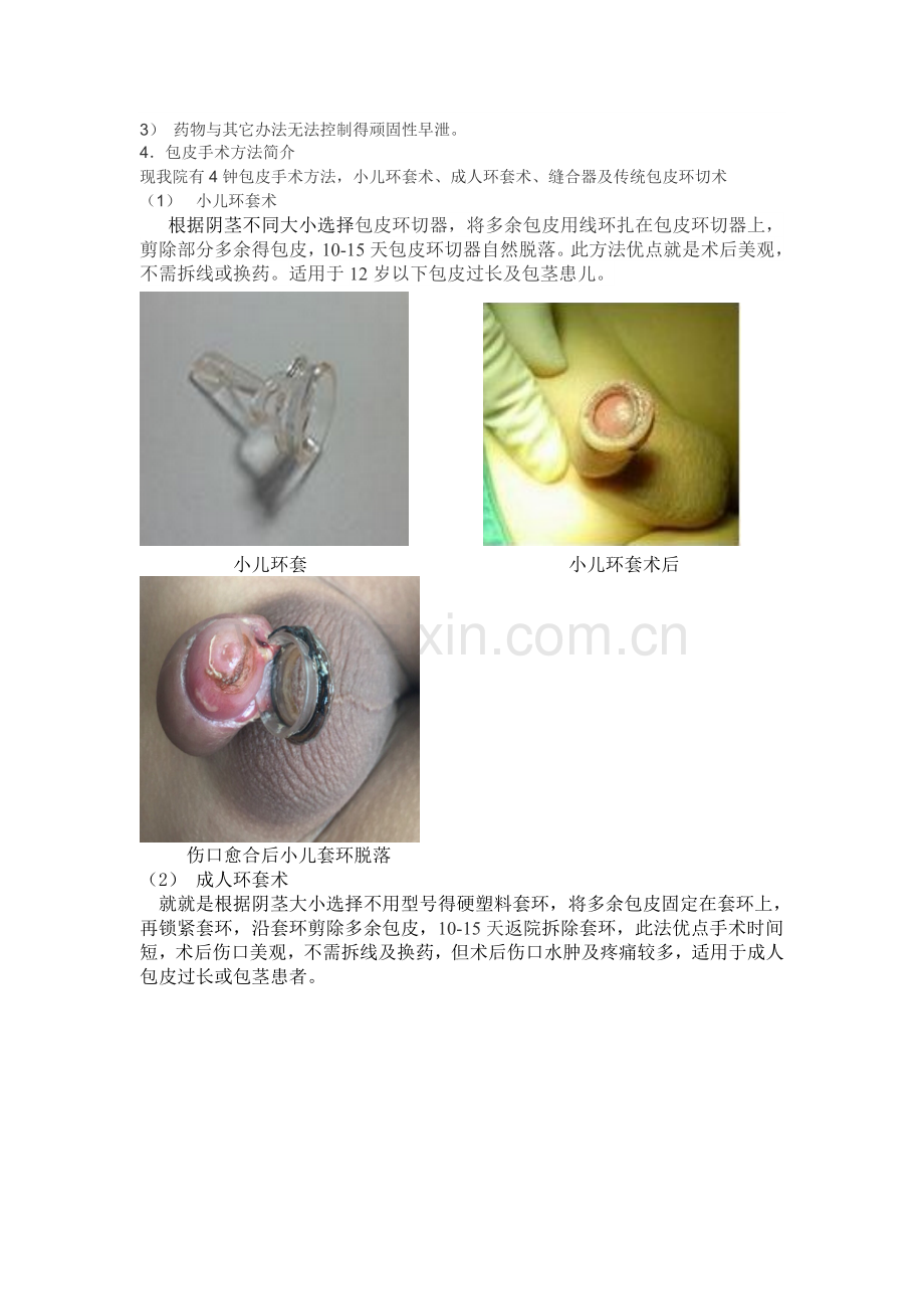 包皮过长及包茎.doc_第2页