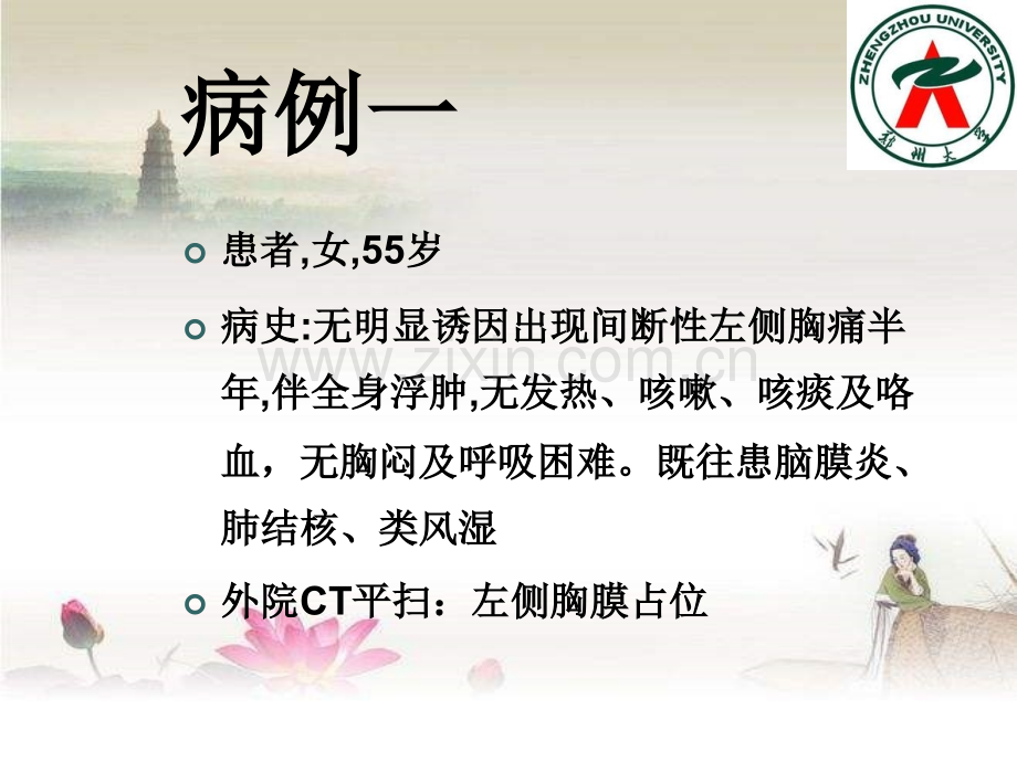 神经鞘瘤.ppt_第2页
