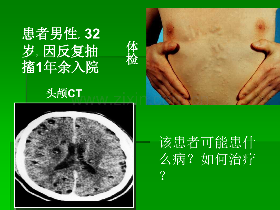 囊尾蚴病.ppt_第2页