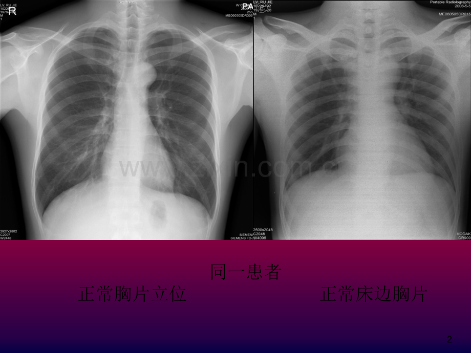 床边胸片分析.ppt_第2页