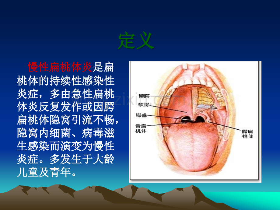 慢性扁桃体炎PPT幻灯片课件.ppt_第2页