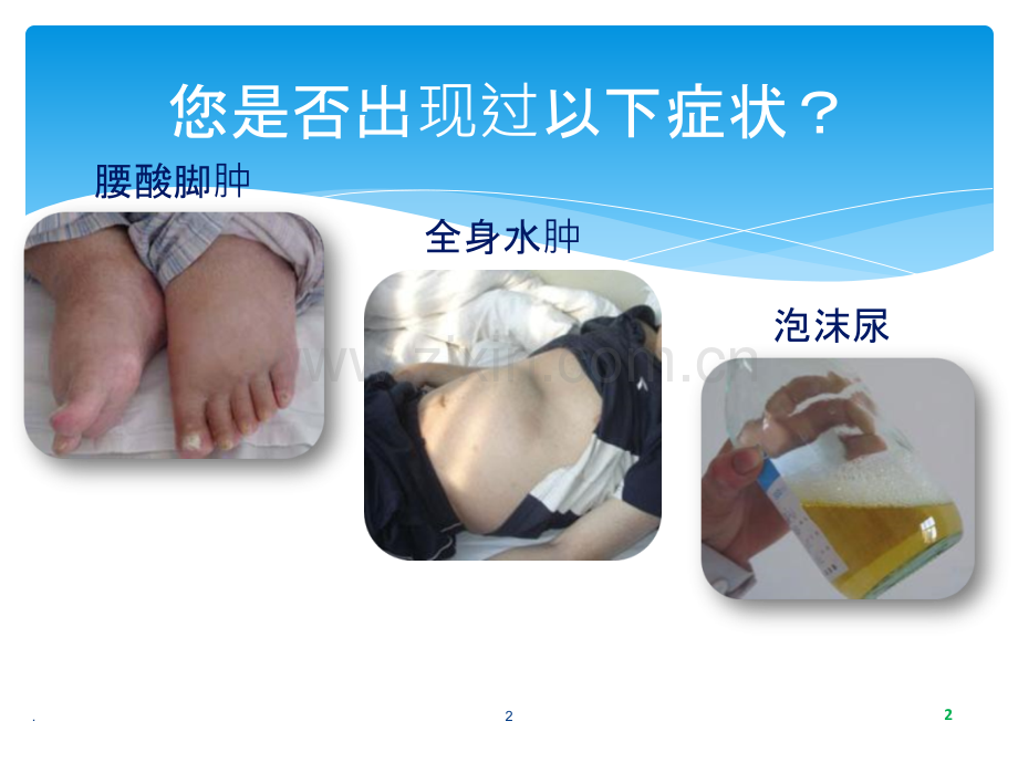 患者教育第篇糖尿病肾病.ppt_第2页