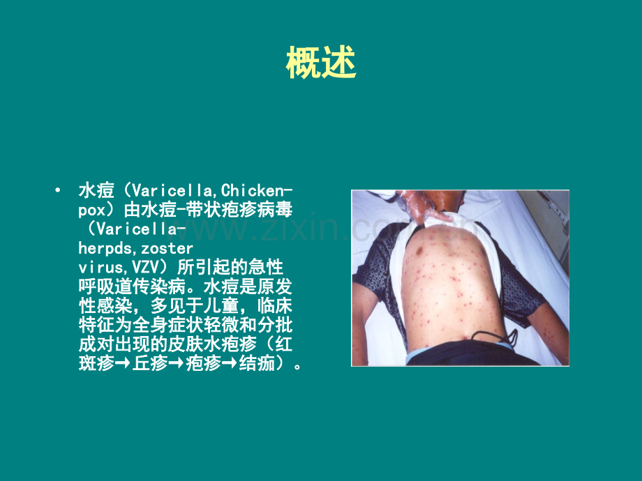 水痘Varicella.ppt_第2页