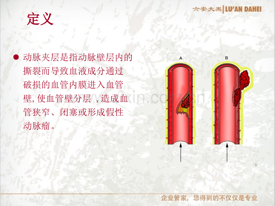 脑动脉夹层.ppt_第2页