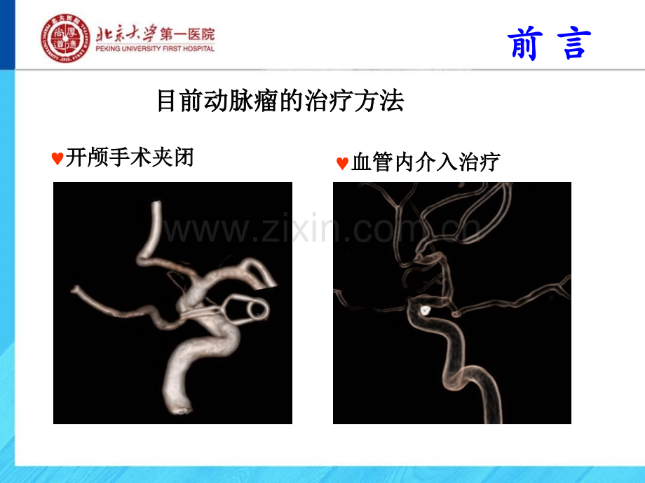 临床医学三维DSA内镜成像在动脉瘤诊治中的作用.pptx_第2页