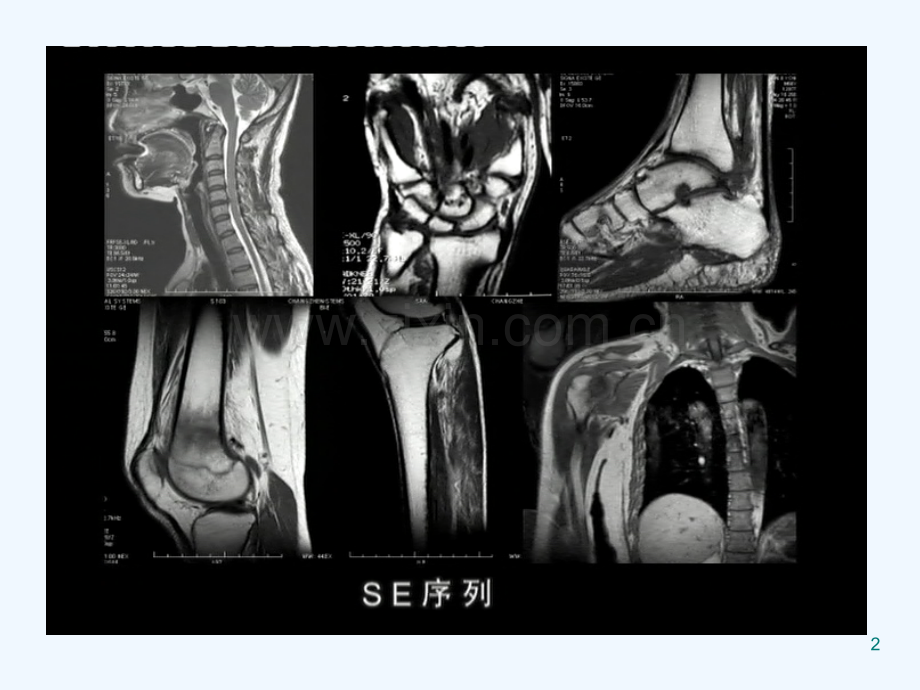 骨关节病MRI诊断(完成)-PPT.ppt_第2页