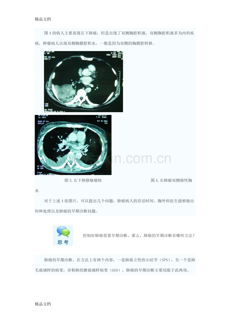 肺内结节鉴别资料.doc_第2页