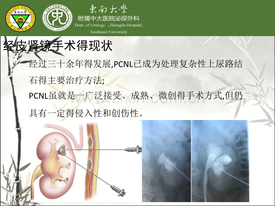 微创经皮肾镜课件.pptx_第2页