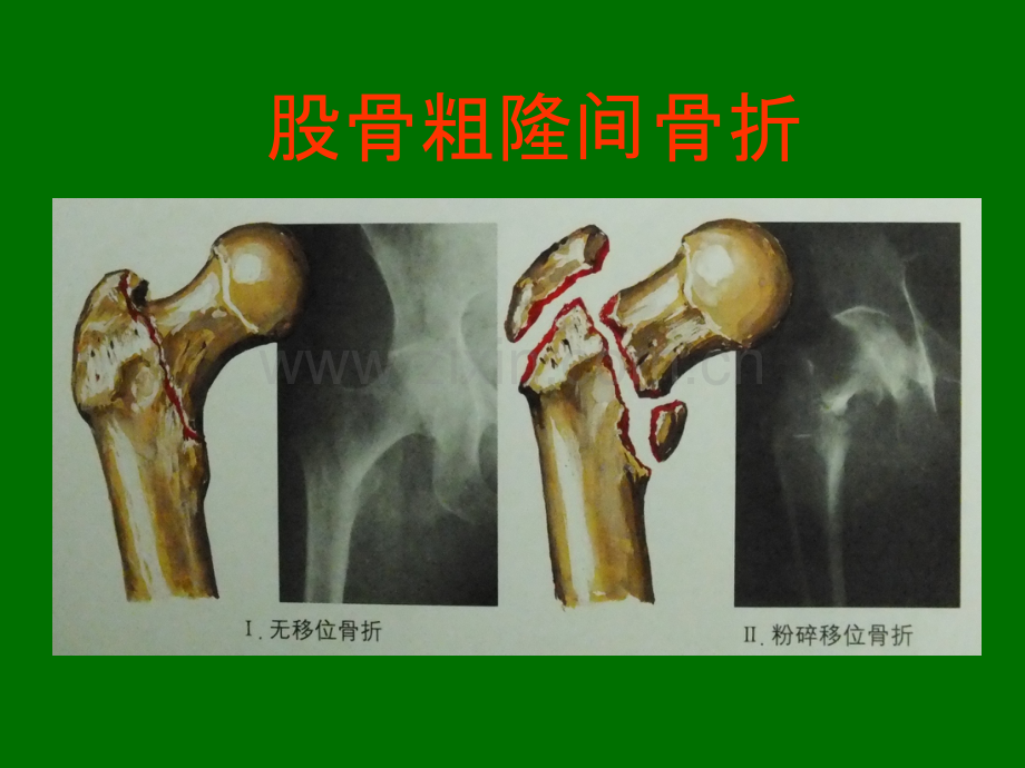 股骨粗隆间骨折44972.ppt_第2页