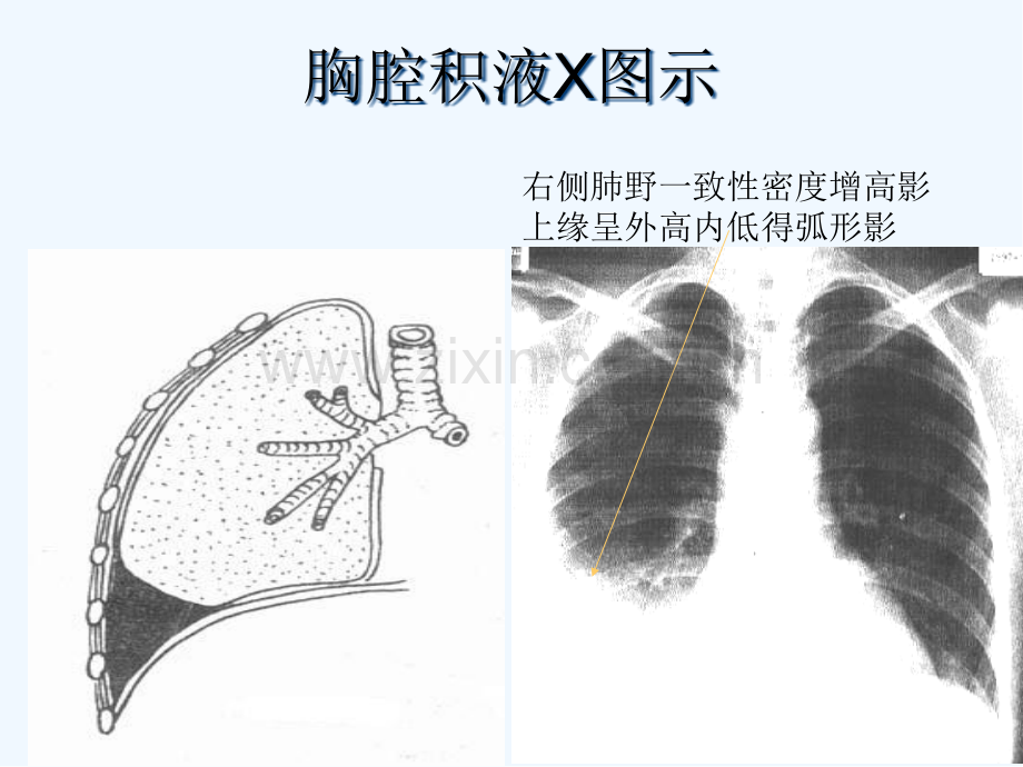 胸膜腔穿刺术-PPT.pptx_第2页