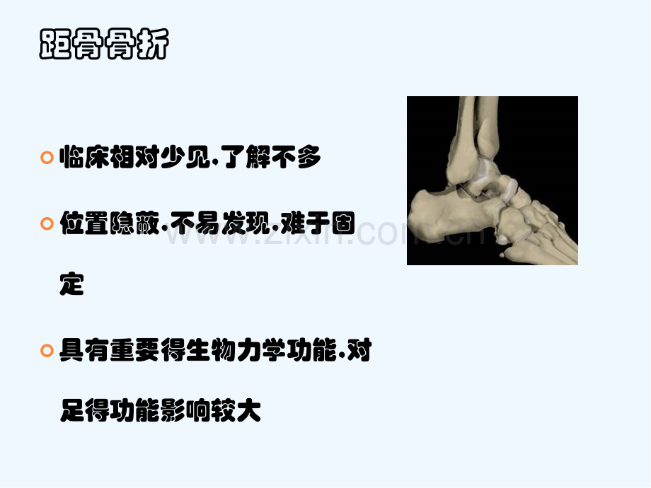 距骨骨折的诊断与治疗策略-PPT.pptx_第2页