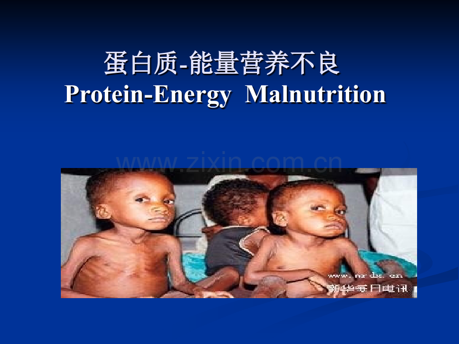 儿科蛋白质能量营养不良.pptx_第1页